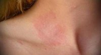 Причини появи алергічних висипань на шкірі