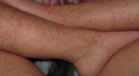 Алергія на пральний порошок – симптоми та причини