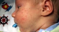 Алергія на гречку у немовляти: ознаки, симптоми, причини і лікування