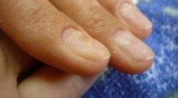 Як лікувати дистрофію нігтьової пластини?