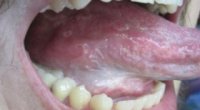 Болить корінь язика: причини і лікування