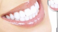 Що робити якщо кришаться зуби: актуальні рекомендації