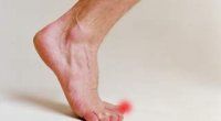 Лікування панарицію на пальці ноги