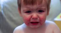 Хвороба кавасакі у дітей: симптоми і лікування