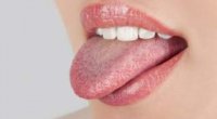 Що робити, якщо пече язик? Причини і лікування недуги