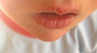 Ефективні заходи та поради для лікування, якщо у дитини верхня губа набрякла