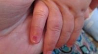 Побутові травми у дітей: що робити, якщо малюк прищемив палець?