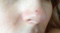 Червоні плями на носі: як боротися і чим усувати