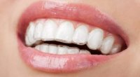 Капи для вирівнювання зубів: плюси і мінуси