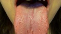 Тріщини на язиці: як можна вирішити цю проблему?