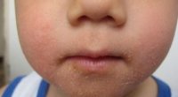 Висип навколо рота у дитини: причини, лікування та профілактика патології