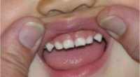 Очні зуби у дітей – коли прорізуються, симптоми, видалення