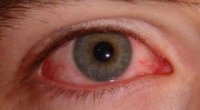 Чому червоніють білки очей і що робити?