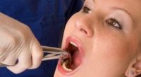 Видалення корінного зуба: чим загрожує і що робити самому пацієнту?