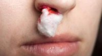 Поліпи в носі у дитини – як лікувати?