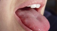 Нарости на язиці: що це таке і чи можна видалити їх?