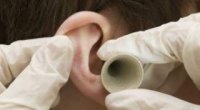 Як вилікувати грибок у вухах медикаментами і народними засобами?