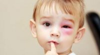 Вірусний кон’юнктивіт у дітей: симптоми і лікування