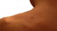 Вугровий висип на спині: причини і лікування