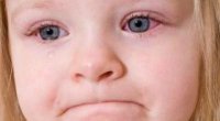 Причини червоних білків очей у дитини і позбавлення від цього симптому