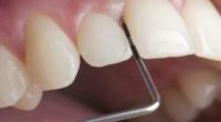 Що таке кюретаж в стоматології? Як проводиться кюретаж