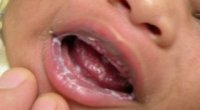 Про що сигналізує білий наліт на губах у немовлят і дорослих?