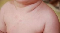 Як вилікувати шершаві плями і почервоніння у дитини на тілі