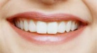 Як нарощують відколотий зуб в стоматологічних клініках? Огляд сучасних методів
