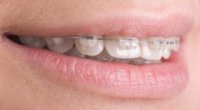 Зуби рівні і не дуже: до чого сняться криві зуби?