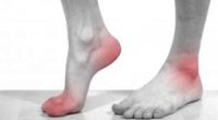 Біль у ступні при ходьбі: причини і лікування