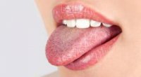 Грибок в роті – причини, симптоми, як лікувати захворювання
