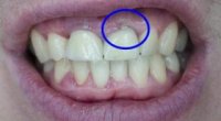 Що робити, якщо з’явилася дірка в зубі і болить?