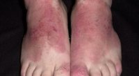 Алергія на ногах: симптоми, діагностика і лікування дітей і дорослих