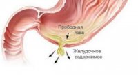 Проривна виразка шлунка: симптоми різних етапів